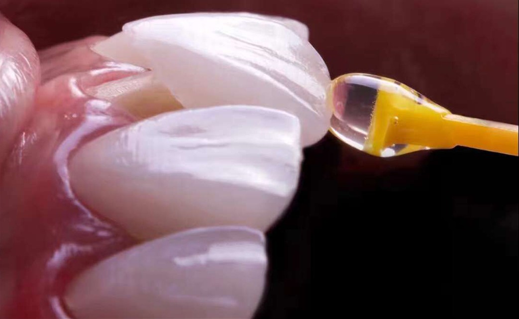 روکش های دندانی چینی، روکش IPS e.max - فوق العاده نازک 0.2 میلی متری، با ظاهر طبیعی طولانی مدت