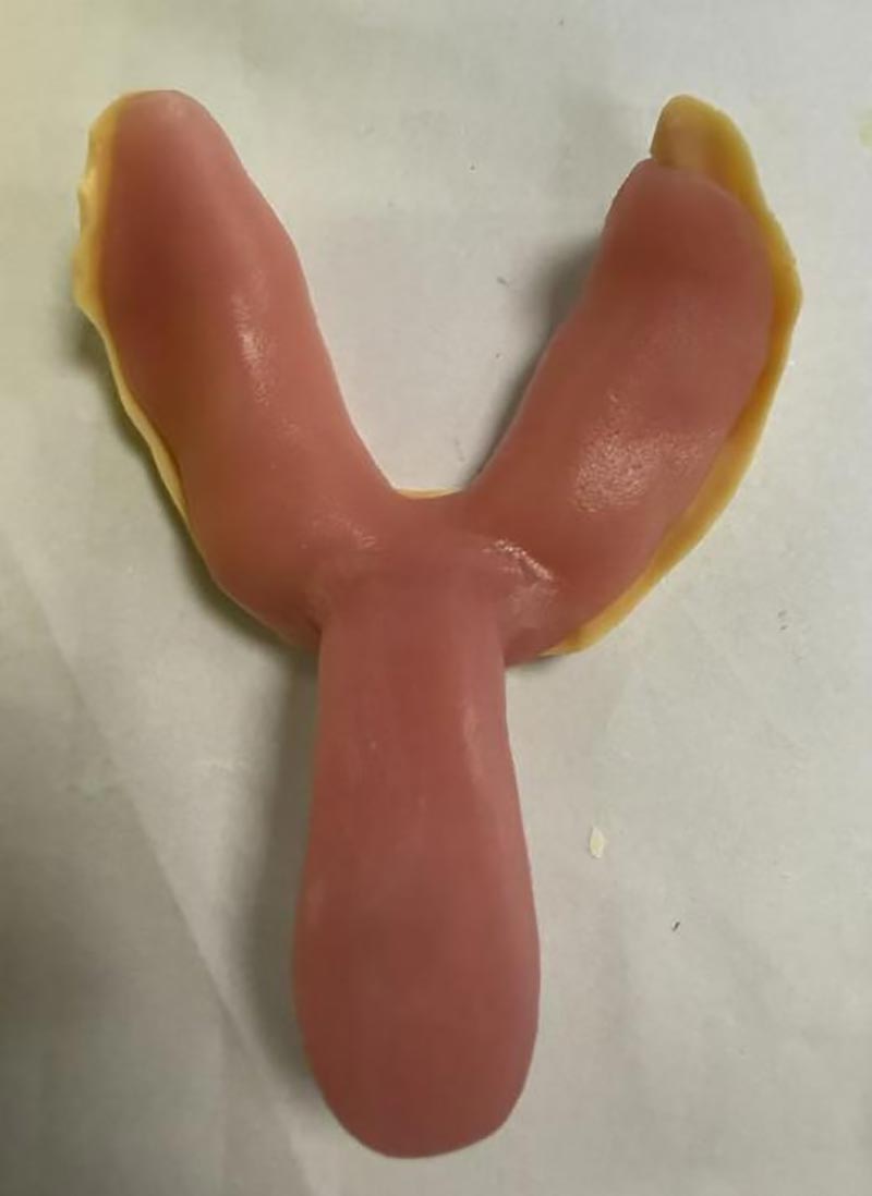 چیزهایی که درباره سینی های دندانپزشکی سفارشی نمی دانستید