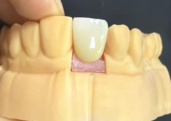 شکاف بین دندان ها را می توان برطرف کرد - دندان های صاف جذاب ترین هستند!