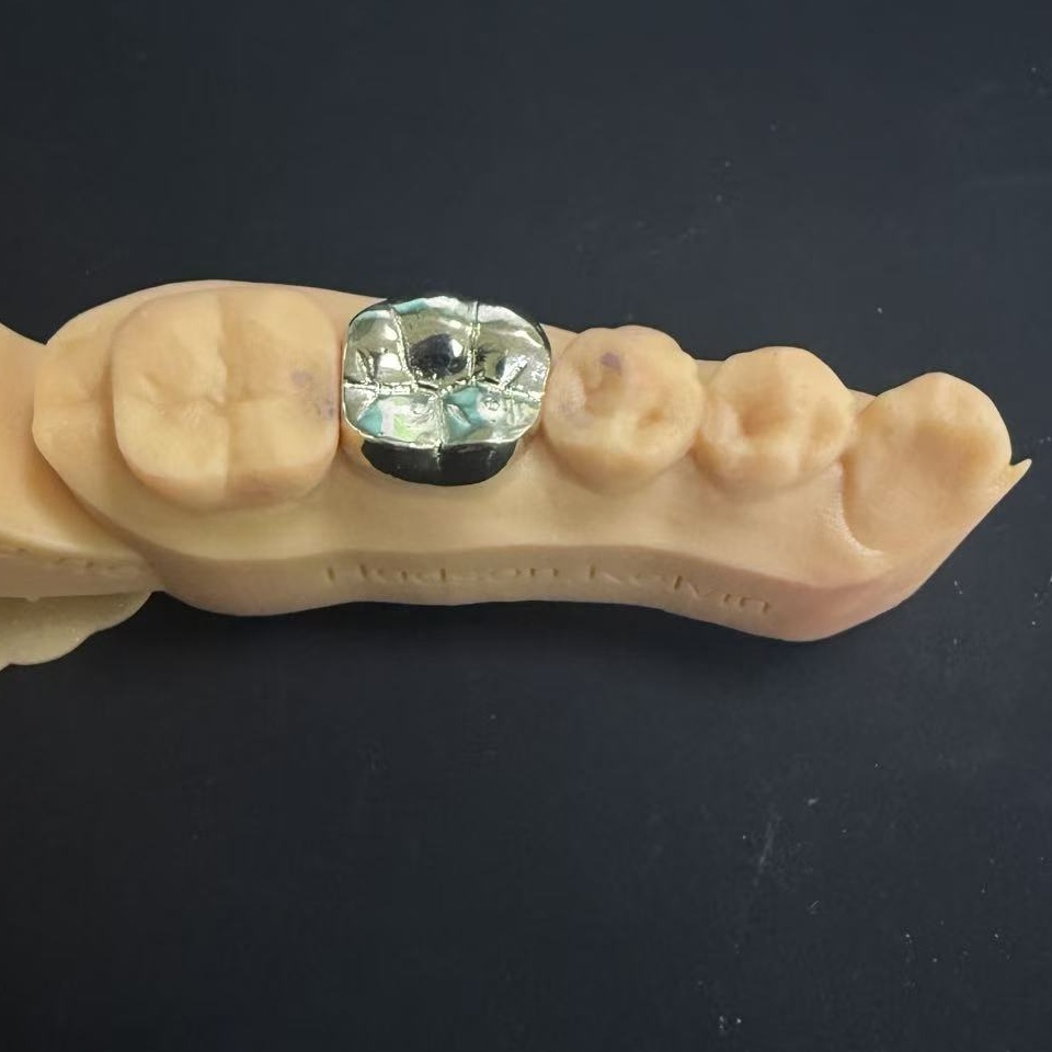 تاج طلا: انتخاب فلز گرانبها برای ترمیم مادام العمر دندان