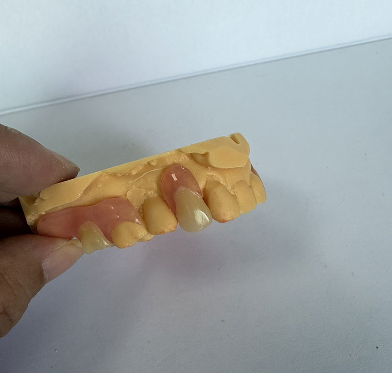 Valplast Partials در آزمایشگاه دندانپزشکی WM