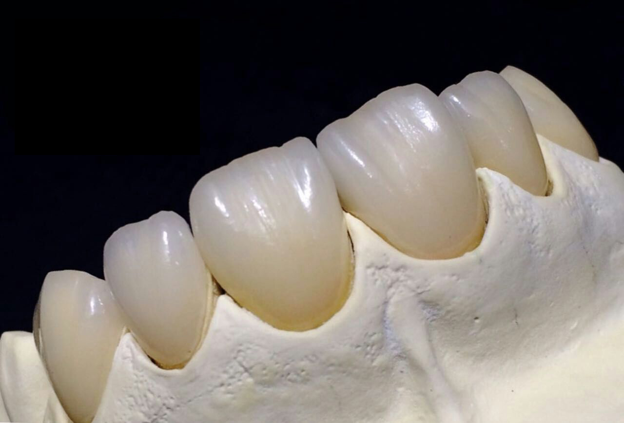 تاج تمام سرامیک
