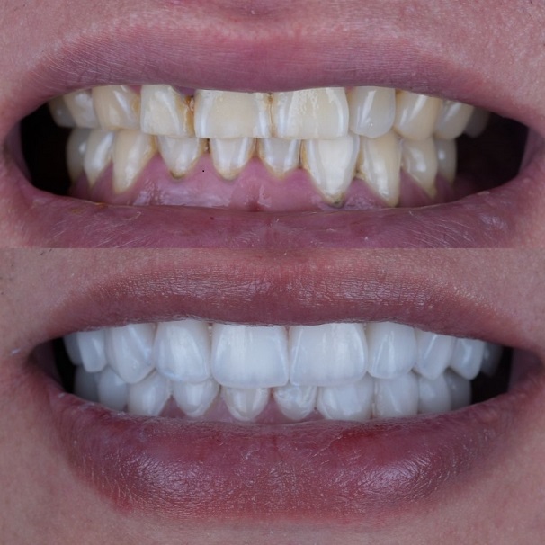 Emax Layered Veneers Esthetic China Dental Lab کار